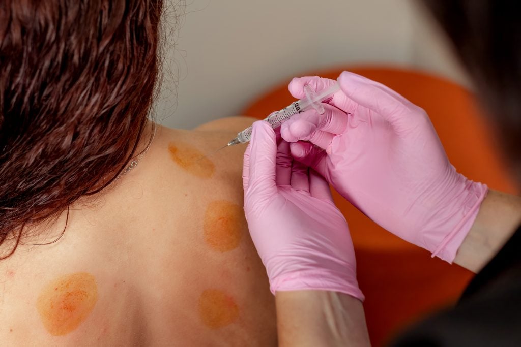 Regenerative medicine treatment being performed on the upper back