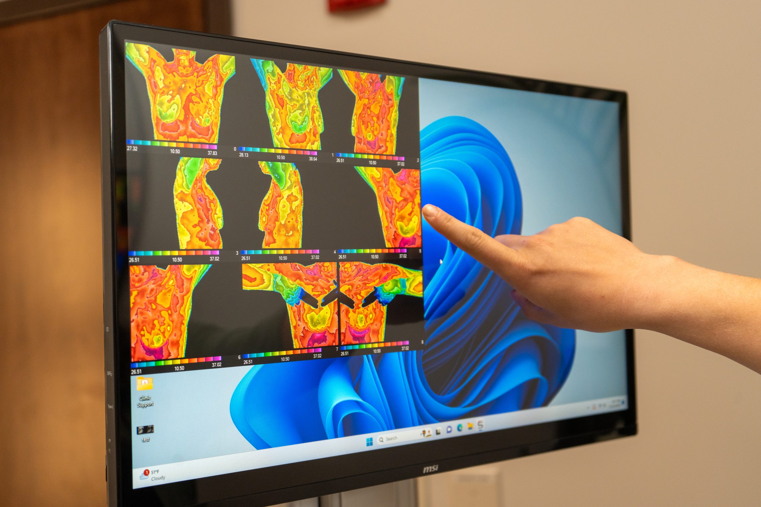 Breast thermography scan displayed on a monitor